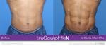 truSculpt Flex Results Image -6398c94f61383